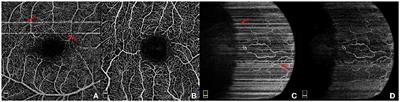 A two-stage framework for optical coherence tomography angiography image quality improvement